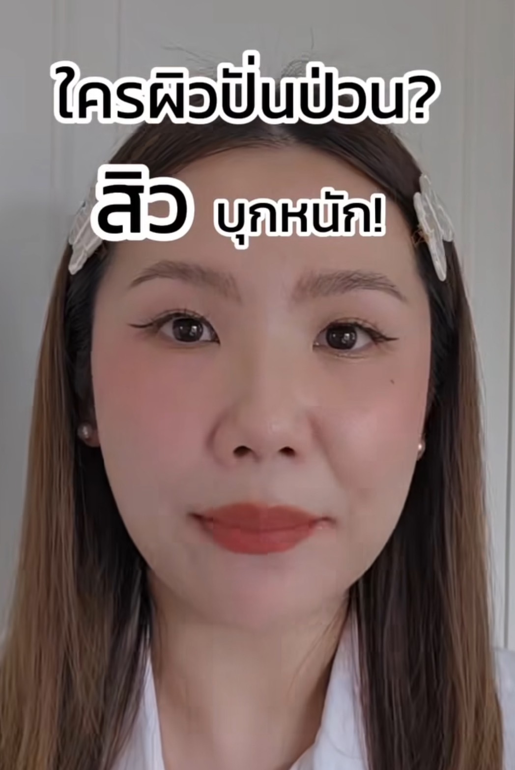 venn คุณ mimi ผิวพัง สิวบุก บาลานซ์ผิวเสีย